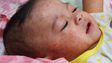 Baby With Measles Photo Source: CDC: https://phil.cdc.gov/Details.aspx?pid=17980
