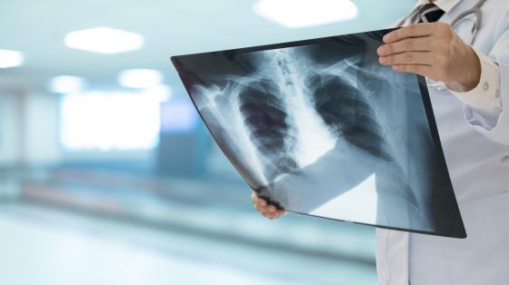 TB Control, Education and Treatment