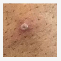 Mpox (formerly monkeypox) Marin Health and Human Services